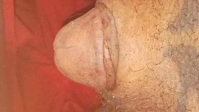 Burning Split Gland Head Into Urethra With Cigarette Tiny Cock and Balls